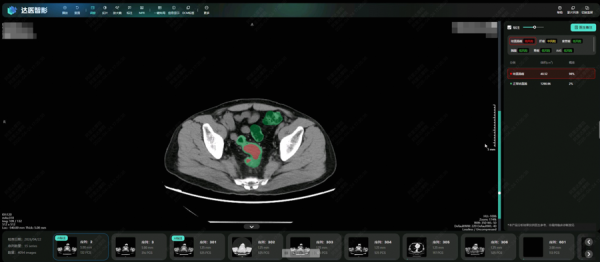 阿里AI全球首次实现肠癌“无感”检测，登上国际肿瘤学顶刊